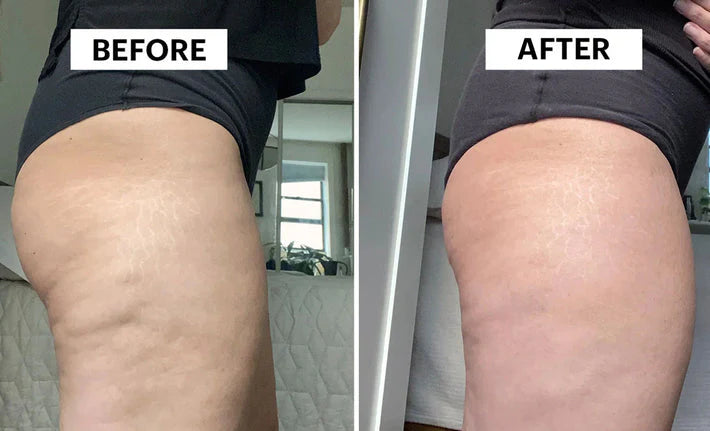Anti-Cellulite Massage